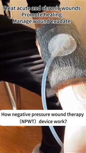 Negative pressure wound therapy devices are mainly used to treat acute and chronic wounds, promote healing, and manage wound exudate. This video demonstrates the normal operation of a negative pressure wound therapy device. #NPWT #MedicalDevice #WoundCare #WoundHealing #Clinical #HealthcareTech #TherapyDevice | 233 Medical