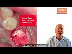 Tip of the Day: Socket Grafting Suturing