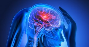 Schlaganfall (Apoplex): Ursachen, Behandlung und Folgen