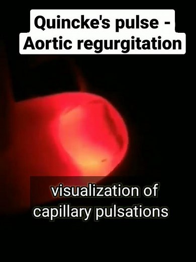 Quincke's pulse - Aortic regurgitation