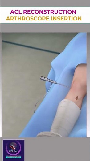 ACL Reconstruction |Arthroscope Insertion Procedure| #shorts