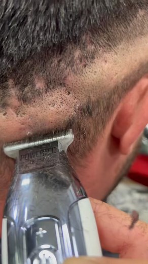 #duet with @Formen ali gür This is one of 5 types of acne scars. If you really want them to be treated see a derm but in this area (scalp) if you grew your hair a little long, this will make them less visible too ♥️ #acne #drpimplepopper. #formenaligür