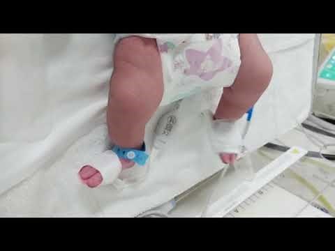 Case 643 How to approach to DDH? hip dysplasia, dislocation,Ortolani& Barlow tests,