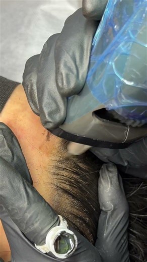 Natural Hairline Restoration for Men with scatter | SMP Tutorial