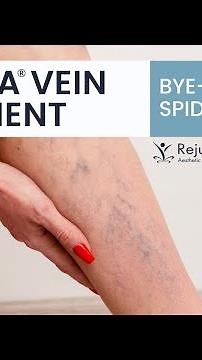 Watch Spider Veins on Legs Be Treated with Asclera
