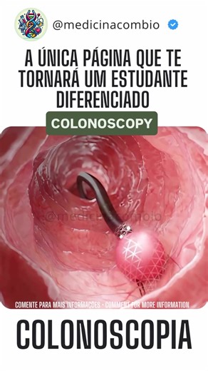 Colonoscopia #colonoscopia #colonoscopy #colon #cancer #medicinacombio