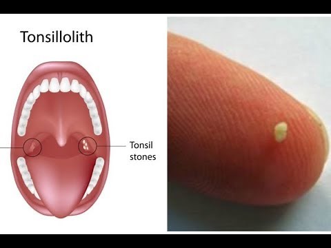 Tonsilloliths (tonsil stones) a patient education video by Carlo Oller, MD