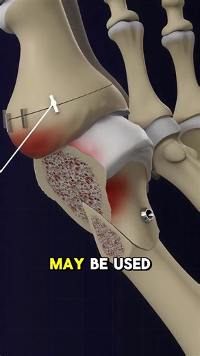 5.7K views · 59 reactions | Bunionectomy (3D Animation) #bunionectomy #bunionectomyprocedure #bunion #bunionsurgeryrecovery #bunionsurgery #bunions #toes #medical3danimation #3dmedicalanimation | Surgery Page | Facebook