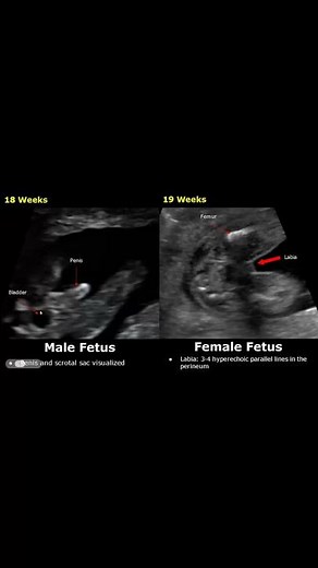 Fetal Gender Determination Ultrasound | 18-19 Weeks Male & Female | Baby Boy/Girl Sex USG #shorts