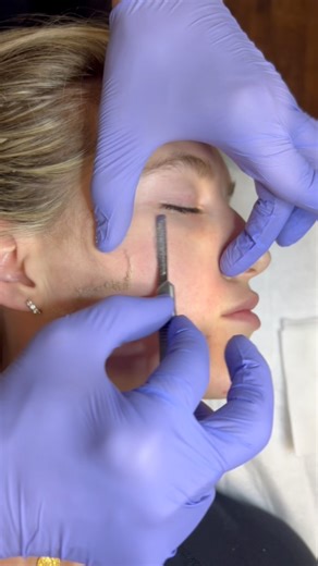 3K views · 24 reactions | Dermaplaning is a non-invasive cosmetic procedure that involves using a sterile surgical scalpel to gently exfoliate the surface of the skin, removing dead skin cells and fine vellus hairs, commonly known as “peach fuzz.” Benefits of dermaplaning include Exfoliation, Smooths skin texture, Diminishes fine lines and wrinkles, Brightens complexion, and helps with product penetration! #WeilerPlasticSurgery | Weiler Plastic Surgery | Facebook