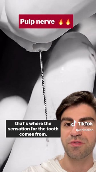 Pulp being removed from tooth #tooth #dentist #rootcanal #teeth