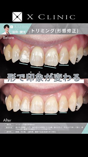 歯のトリミング：自然なバランスを整える治療