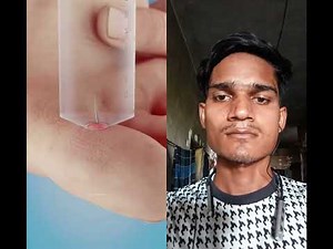 How Suction Splinter Removal Works