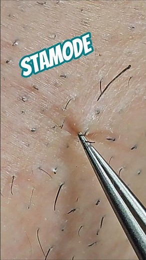 Deep Ingrown Beard Hair Pull ASMR 🧔 #beard #tweezing #plucking #satisfying #fyp