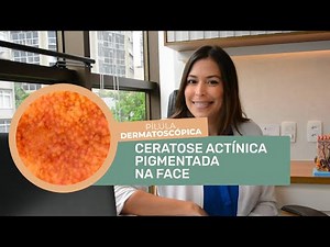 PÍLULA DERMATOSCÓPICA 55: CERATOSE ACTÍNICA PIGMENTADA NA FACE