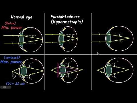 Defects of vision | The human eye and the colourful world | Physics class 10 | Khan Academy