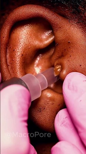 This Ear Comedone Kept Stretching 😳 | Vacuum Extraction ASMR