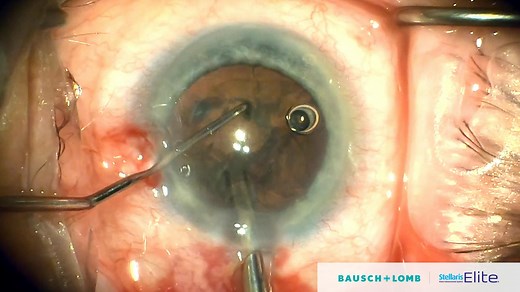 Manage All Cataract Densities With the Stellaris Elite® System - Eyetube