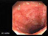 Endoscopy Of Ulcerative Colitis (2 of 3) • Video • MEDtube.net