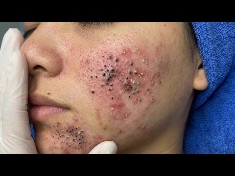 Relax Every Day Sac spa 11115 11115 Blackhead removeal 2026 Today show #satisfying #sacdepspa #asmr