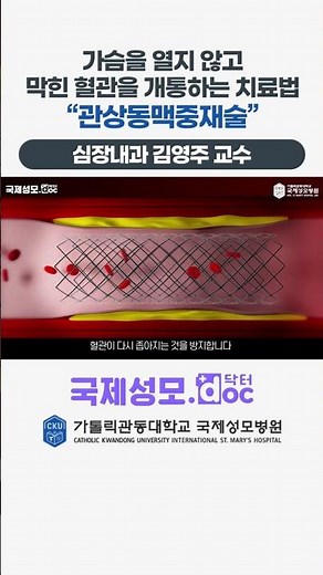 "Percutaneous Coronary Intervention," a treatment that opens blocked blood vessels without openin...