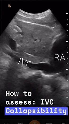 IVC Collapsibility Ultrasound