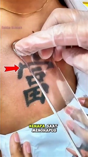 Why is tattoo removal with gel so popular? 🤔