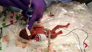 World’s tiniest surviving micro-preemie born at San Diego hospital