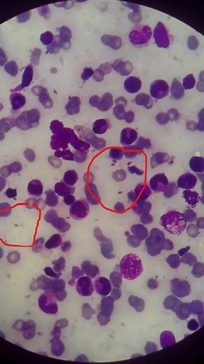 Leishmania Amastigotes in Bone Marrow Smear. الطور التشخيصي لطفيل اللشمانيا في مسحة من نخاع العظم تحت المجهر. #صفحةفن الطب التشخيصي المخبري. #بإختصار. | فن الطب التشخيصي المخبري