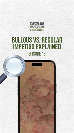 Dr. Boswell | Board-Certified Dermatologist on Instagram: "Bullous impetigo isn’t just “staph on the skin.” A virus infects the staph bacteria, triggering toxins that cleave desmoglein-1 → flaccid blisters peel like Saran wrap. 😳 🔗 Catch the newest episode on Spotify or Apple Podcasts. 💬 Drop a 🎙️ “PODCAST” in the comments for the link. ⚠️DISCLAIMER: This is for educational purposes only. NOT medical advice. — #BullousImpetigo #StaphInfection #DermEducation #DermTips #MedEd #MedicalDerm #Ski