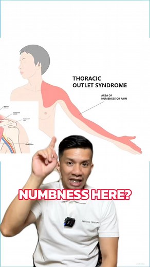94K views · 882 reactions | How to test & treat Thoracic Outlet Syndrome!! #thoracicoutletsyndrome #physicaltherapy | Keep Moving | Facebook