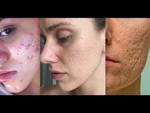 Types Of Acne Scars