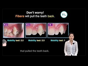 How to fix a overpulled impacted tooth?｜【Chris Chang Ortho】CC676
