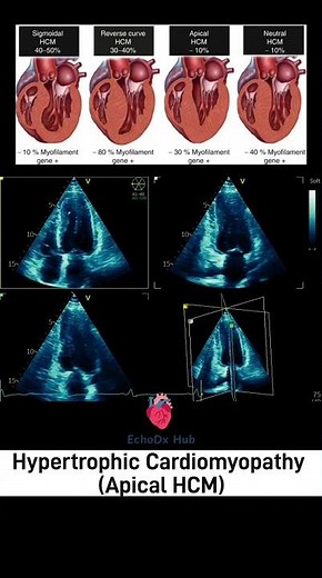 Apical Hypertrophic Cardiomyopathy #ApicalHCM #HypertrophicCardiomyopathy #AceOfSpadesHeart #Echo