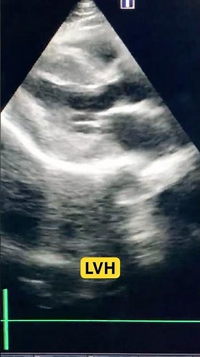 Left ventricular hypertrophy on Echo | LVH | Hypertensive Hypertrophy