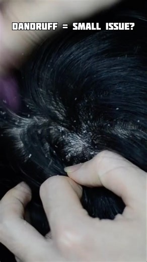 How to Remove Dandruff Fast 🔥Anti Dandruff Shampoo #dandruff