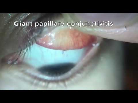 Giant papillary conjunctivitis