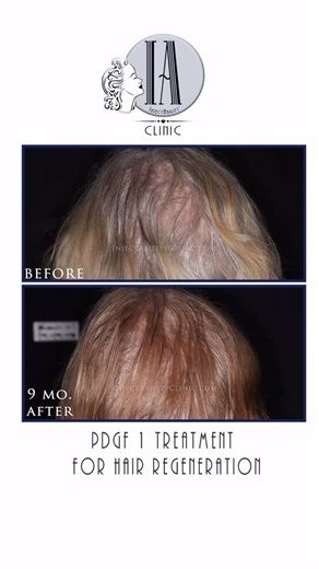 Leslie Fletcher | 🧬 The Science Behind PDGF for Hair Restoration 🧬 Platelet-Derived Growth Factor (PDGF) is revolutionizing hair restoration by working at... | Instagram