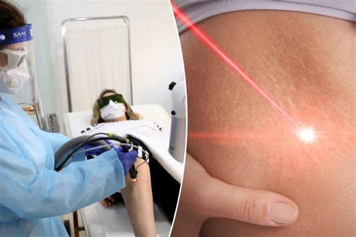 Wrinkles begone: Dermatologists reveal the best lasers for lines, sagging, stretch marks and spots