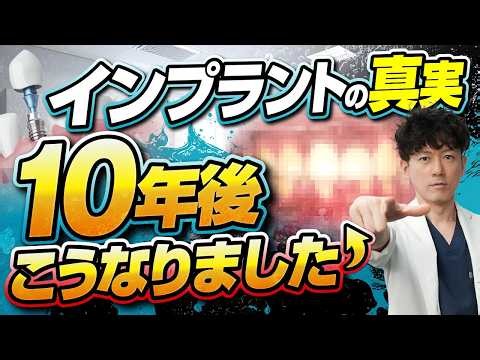 インプラント10年後のリアルを歯医者が解説！長持ちする人とダメになる人の違い