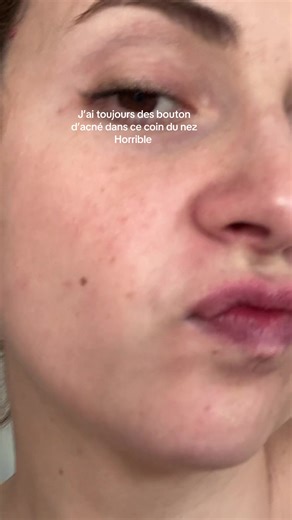 Si ce n’est pas là c’est à la pointe du nez 😮‍💨 #bouton #pimple