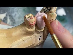 Tooth #23 Shape Explained