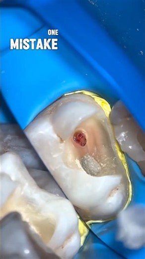5 Tricks Every Dentist Must Know for MTA Pulp Capping