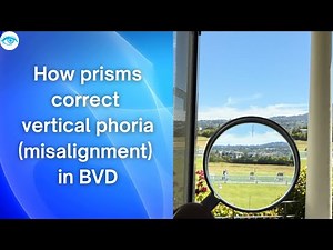 ‪@eyeoptometrist‬ How prisms correct vertical phoria (misalignment) in BVD