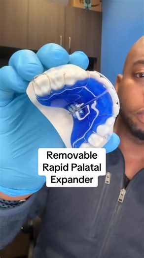 Dr Jesse McGuire on Instagram: "This is a removable rapid palatal expander! 😱🦷 #prosmilesorthodontics #orthodontics #braces #dentistry #expanders"