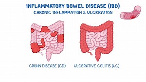Video: Inflammatory bowel disease: Nursing pathophysiology - Video Explanation! | Osmosis | Osmosis