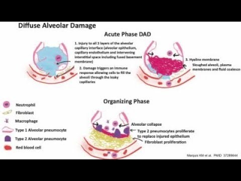 Diffuse Alveolar Damage DAD; hallmark of Acute Respiratory Distress Syndrome ARDS