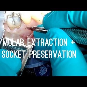 Molar Extraction with Socket Preservation with Bioxclude Membrane