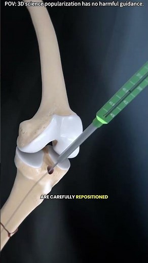Tibia fracture surgery