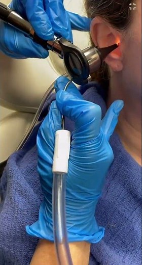Ear wax removal using suction by an ENT